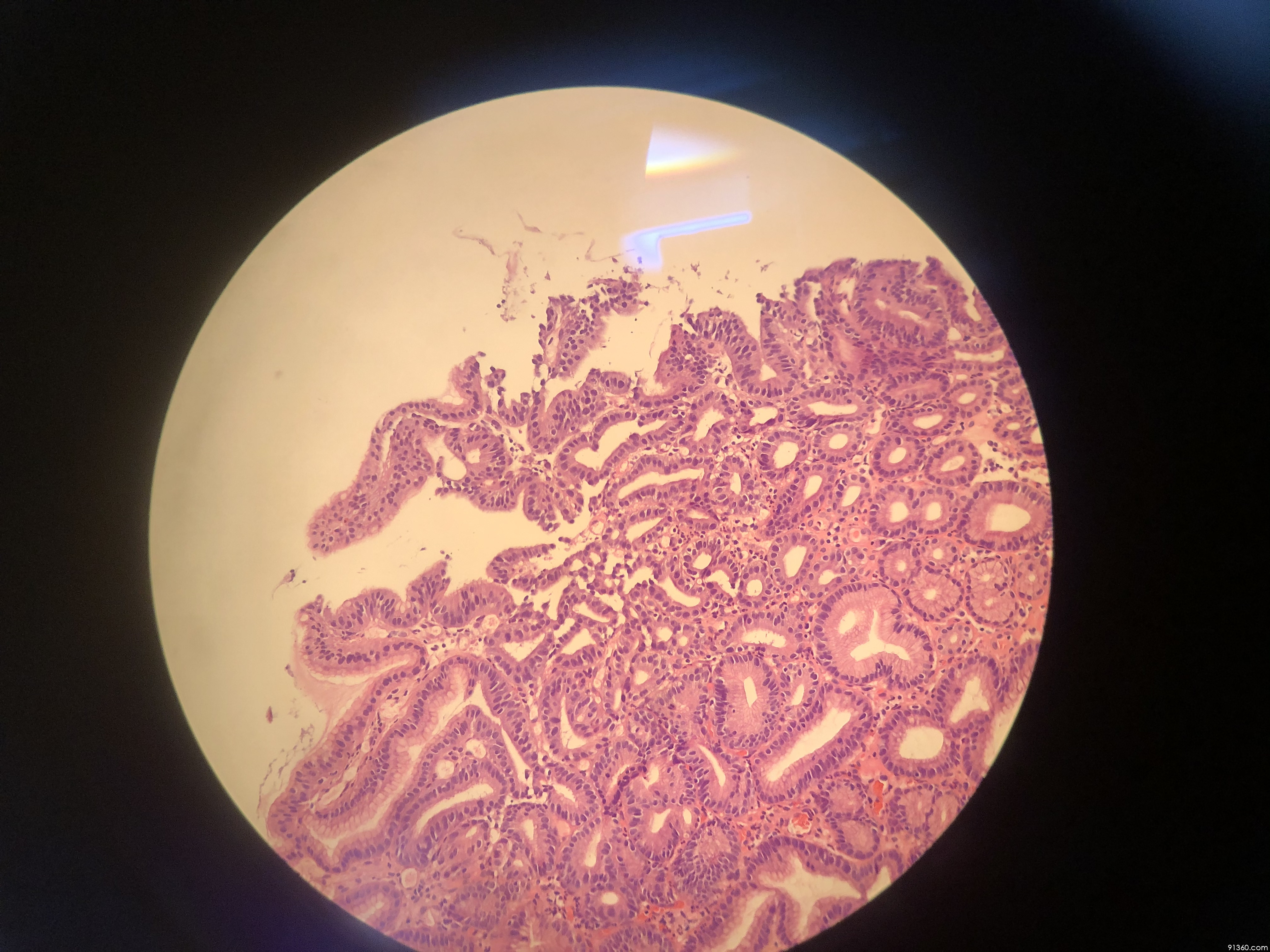 胃镜活检:小凹上皮型腺瘤?讨论病例【山东省消化道早癌病理群228】