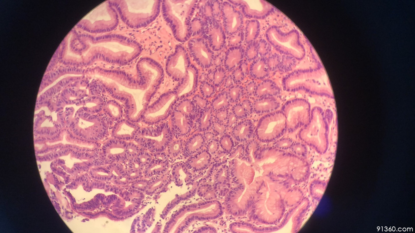 胃镜活检:小凹上皮型腺瘤?讨论病例【山东省消化道早癌病理群228】