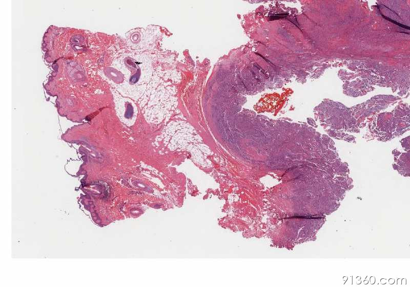 左枕部:滑膜肉瘤?讨论病例【91360.软组织786】
