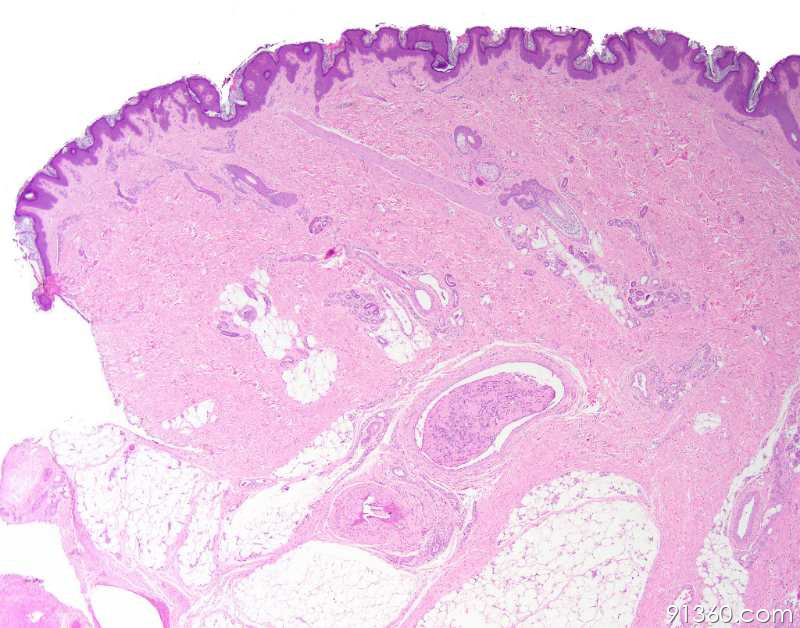 皮肤：intravascular Lobular Capillary Hemangioma讨论病例【91360.软组织792】 - 软组织病理 ...