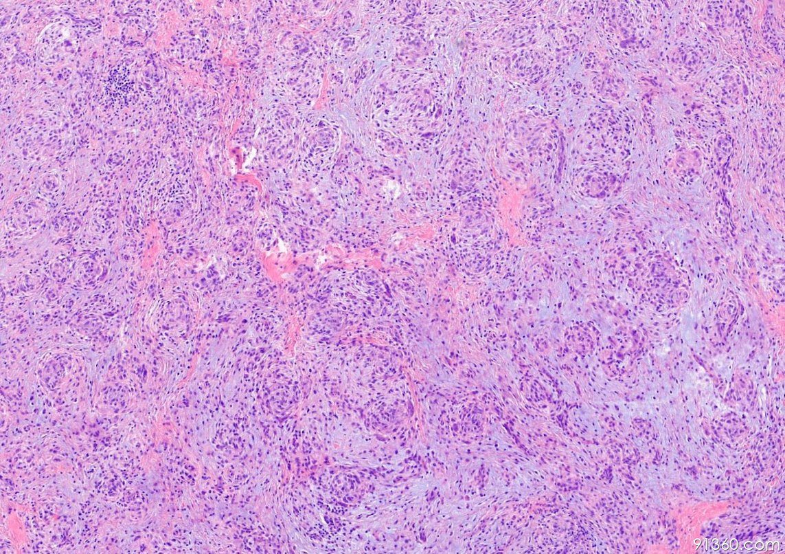 cellular-neurothekeoma-91360-816-91360