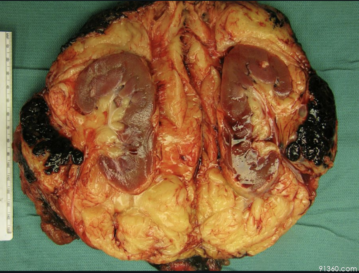 肾肿瘤图片早期图片