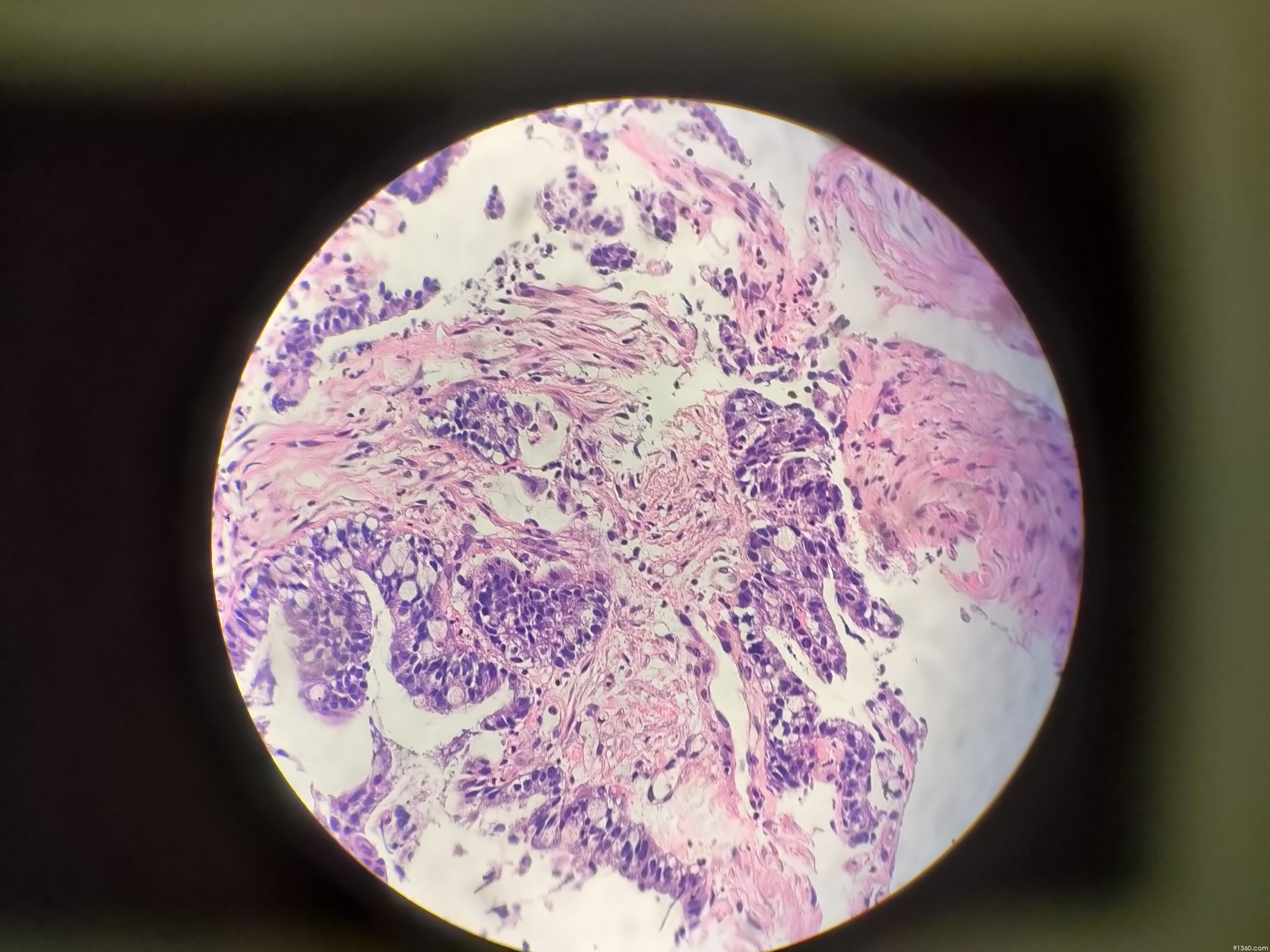 结肠腺癌显微镜图片图片