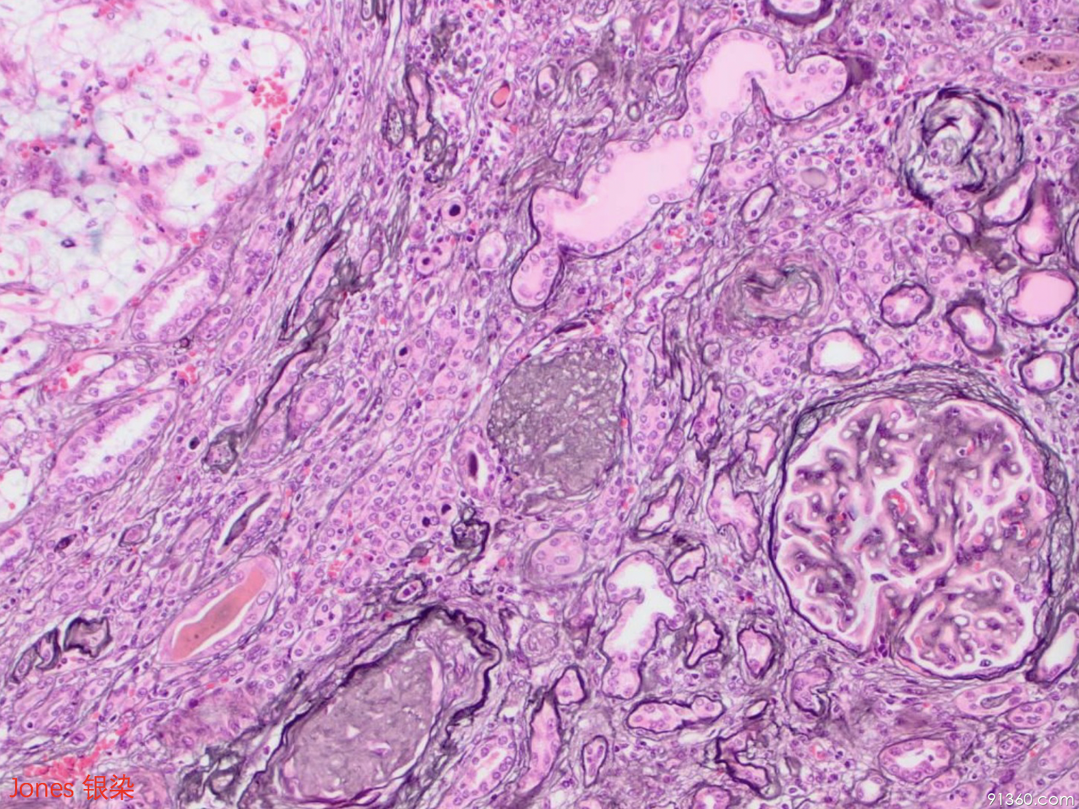 肾透明细胞癌肿瘤图片图片