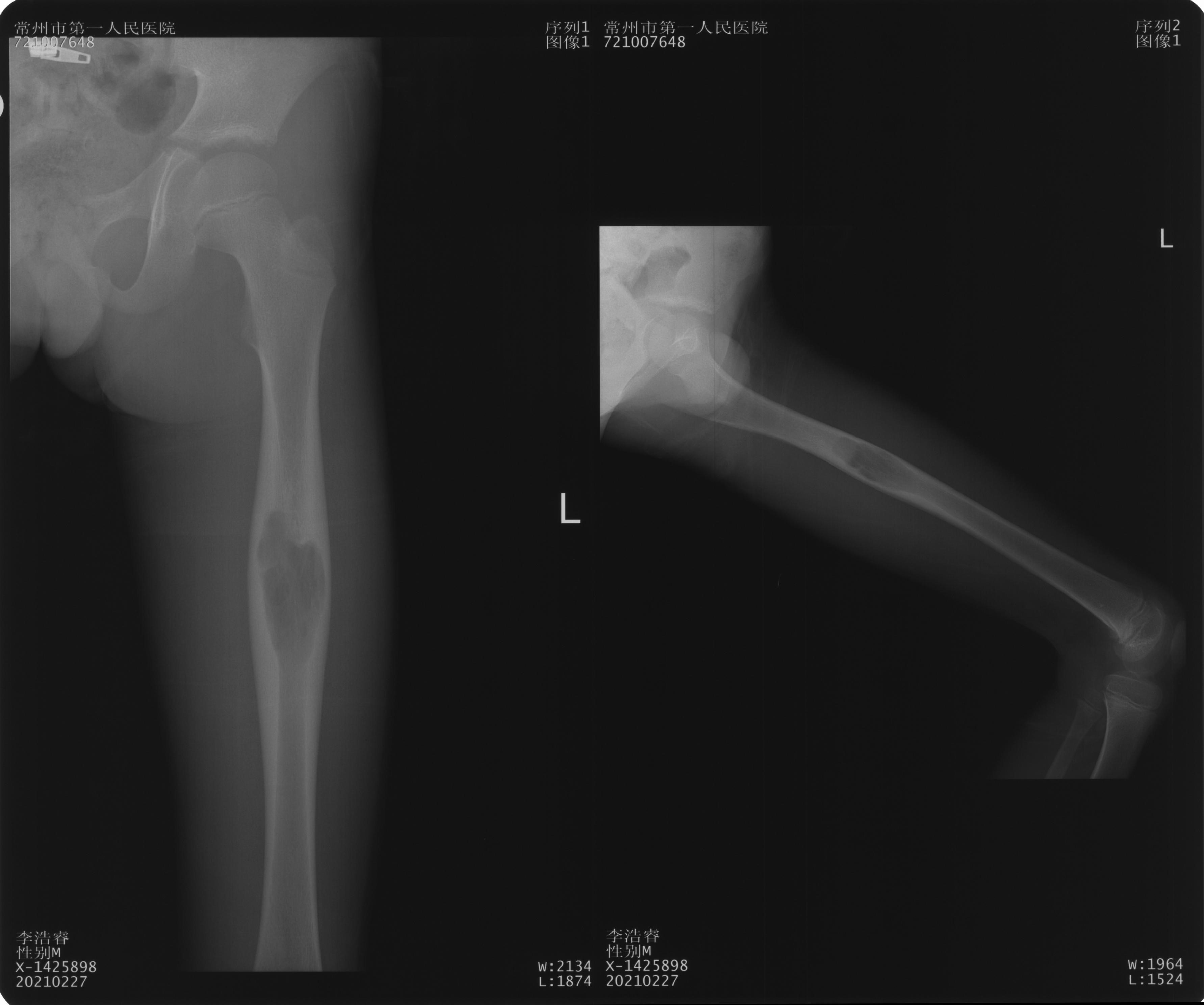 第七节 小腿部软组织缺损的显微修复