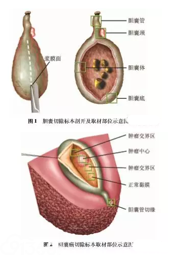 多学科团队开展胆道肿瘤病理学取材及报告规范化的意义