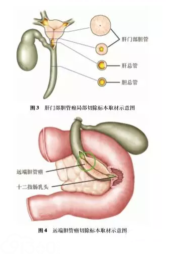 多学科团队开展胆道肿瘤病理学取材及报告规范化的意义