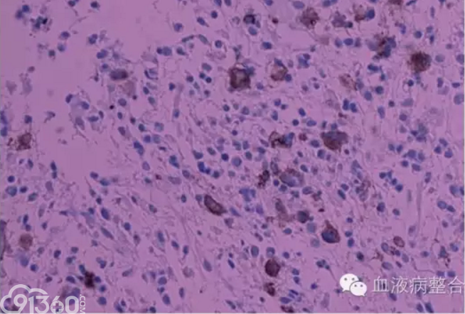 病态巨核细胞和胞体大小核叶高低巨核细胞形态学