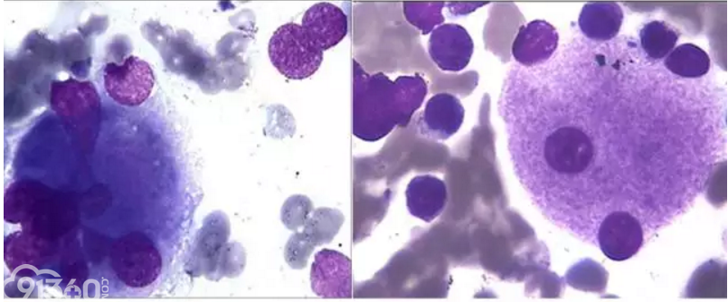 病态巨核细胞和胞体大小核叶高低巨核细胞形态学