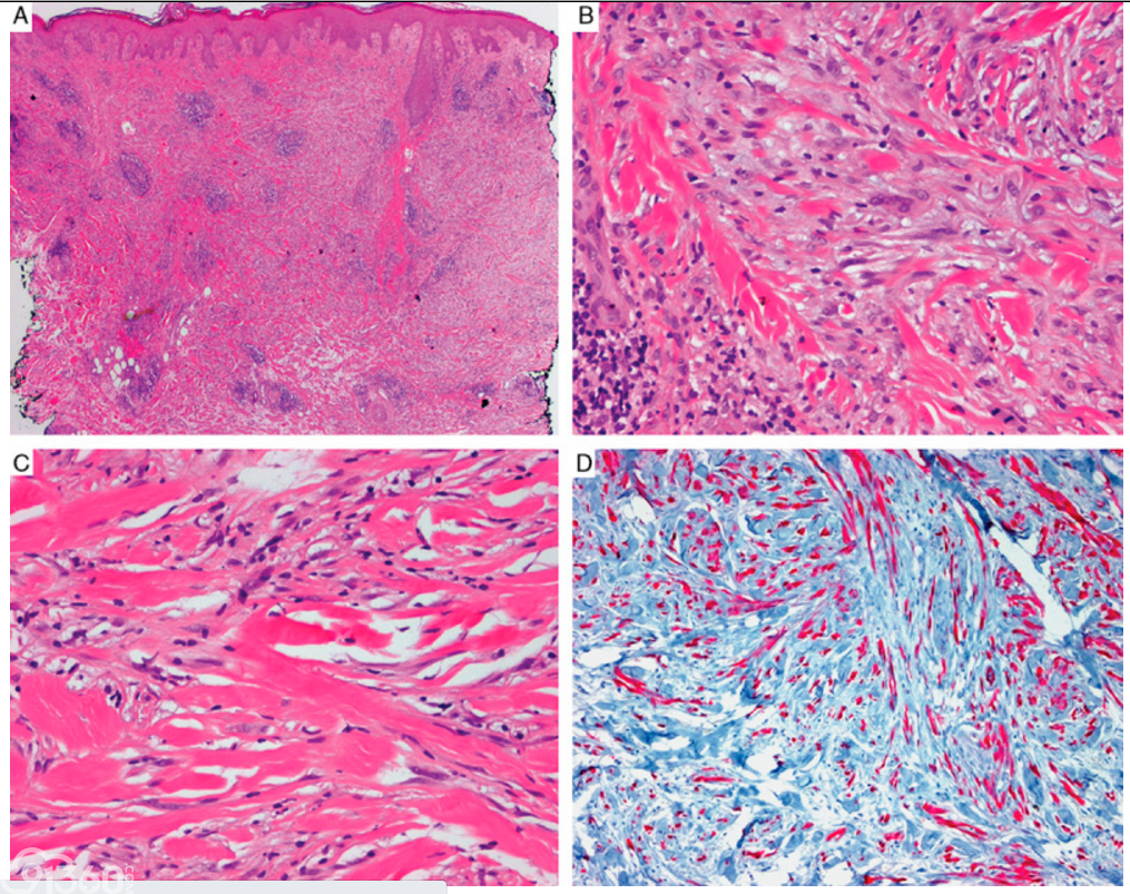 Data Set for Pathology Reporting of Cutaneous Invasive Melanoma