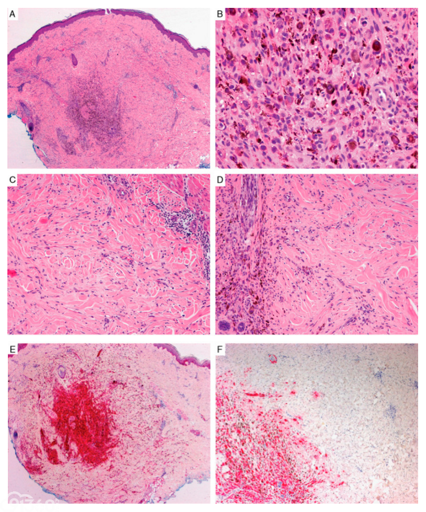 Data Set for Pathology Reporting of Cutaneous Invasive Melanoma