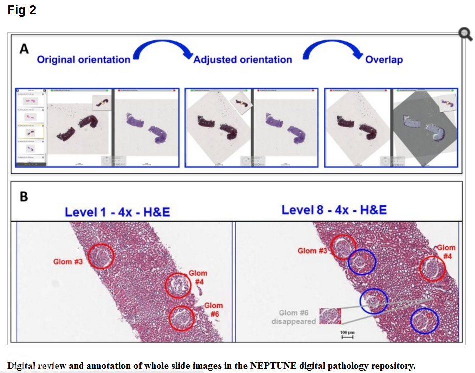 The Application of Digital Pathology to Improve Accuracy in Glomerular Enumeration in Renal Biopsies