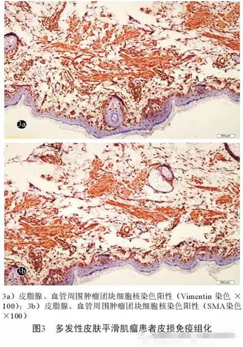 41岁男性患多发性皮肤平滑肌瘤入院治疗病例分析