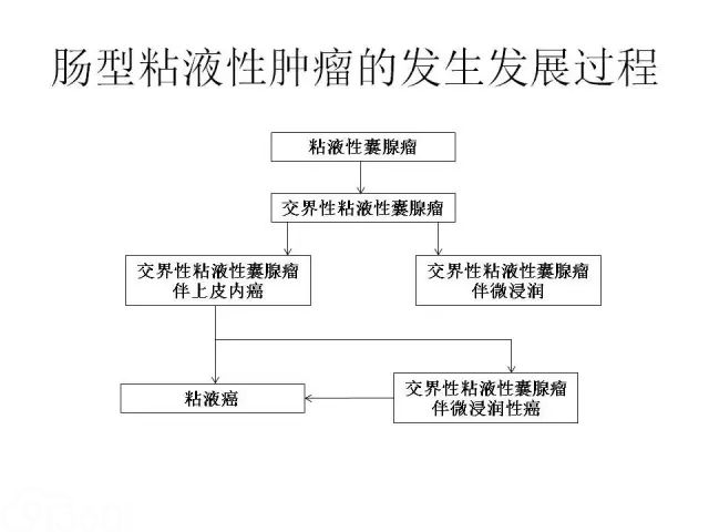 卵巢癌的病理诊断新进展 四 91360智慧病理网
