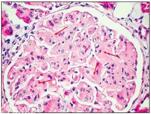 肾内病理图解：有形结构沉积肾小球病
