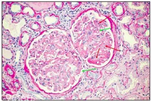 肾内病理图解：有形结构沉积肾小球病