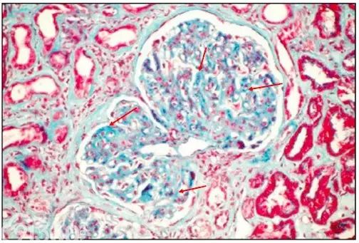 肾内病理图解：有形结构沉积肾小球病