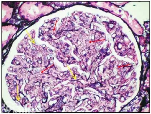 肾内病理图解：有形结构沉积肾小球病