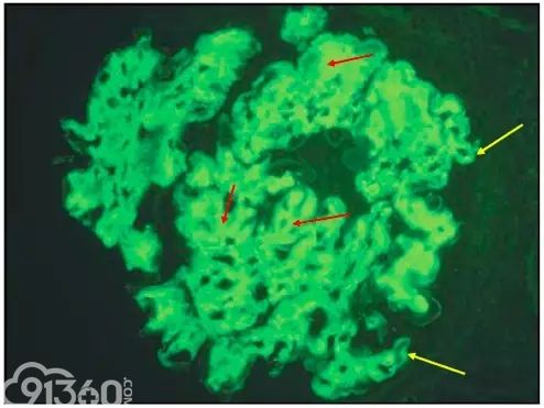 肾内病理图解：有形结构沉积肾小球病
