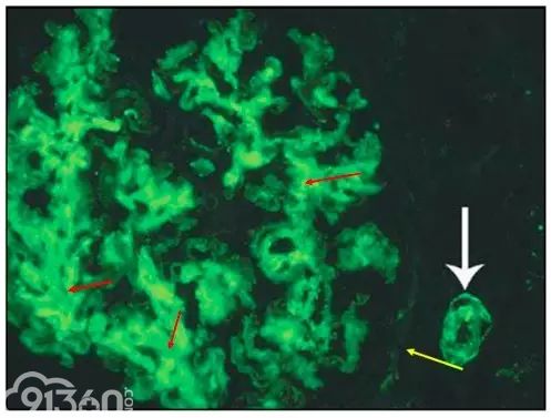 肾内病理图解：有形结构沉积肾小球病