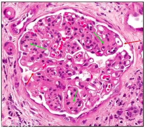 肾内病理图解：有形结构沉积肾小球病