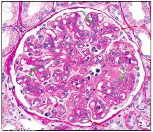 肾内病理图解：有形结构沉积肾小球病