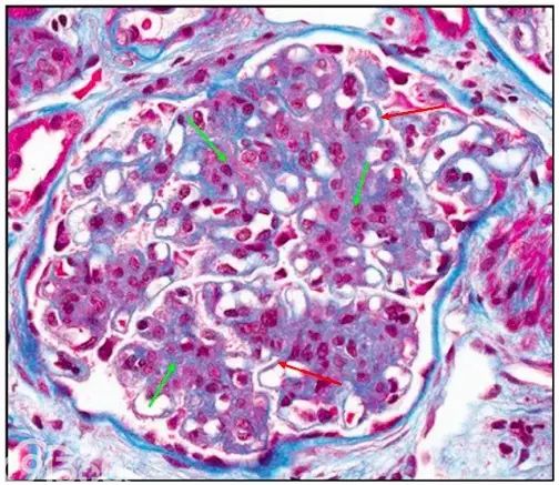 肾内病理图解：有形结构沉积肾小球病