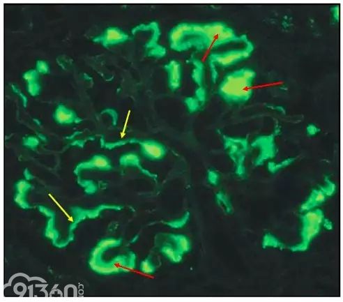 肾内病理图解：有形结构沉积肾小球病