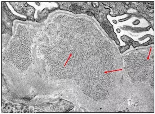 肾内病理图解：有形结构沉积肾小球病