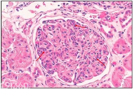 肾内病理图解：有形结构沉积肾小球病