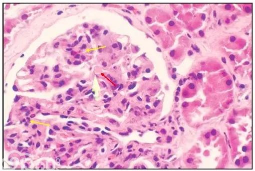 肾内病理图解：有形结构沉积肾小球病