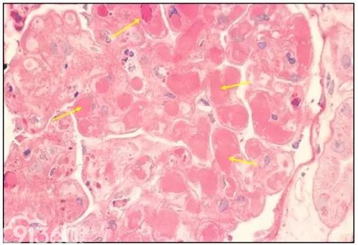 肾内病理图解：有形结构沉积肾小球病
