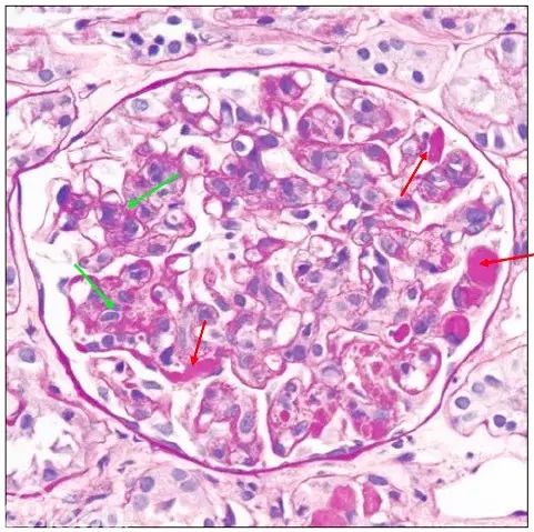 肾内病理图解：有形结构沉积肾小球病