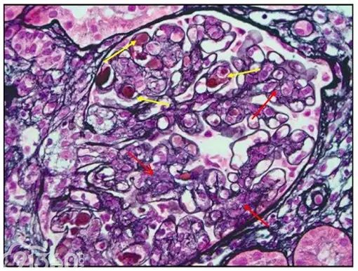 肾内病理图解：有形结构沉积肾小球病