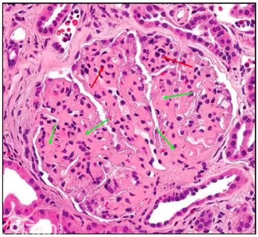 肾内病理图解：有形结构沉积肾小球病