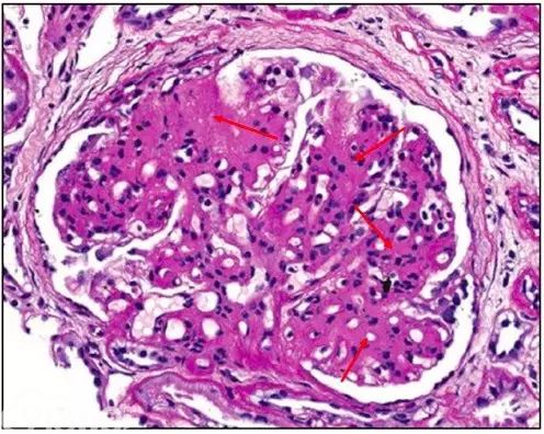 肾内病理图解：有形结构沉积肾小球病