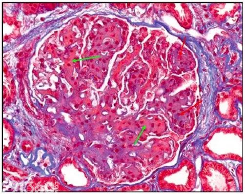 肾内病理图解：有形结构沉积肾小球病