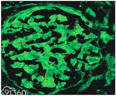 肾内病理图解：有形结构沉积肾小球病