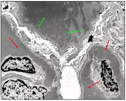 肾内病理图解：有形结构沉积肾小球病