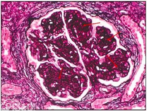 肾内病理图解：有形结构沉积肾小球病