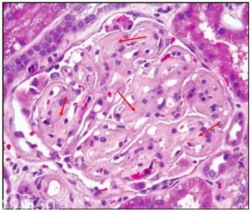 肾内病理图解：有形结构沉积肾小球病