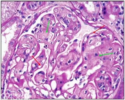 肾内病理图解：有形结构沉积肾小球病