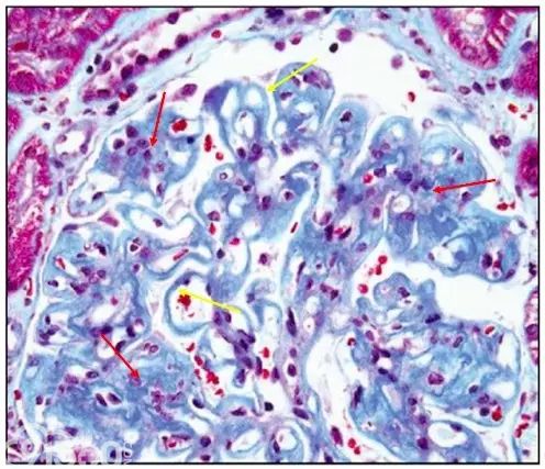 肾内病理图解：有形结构沉积肾小球病