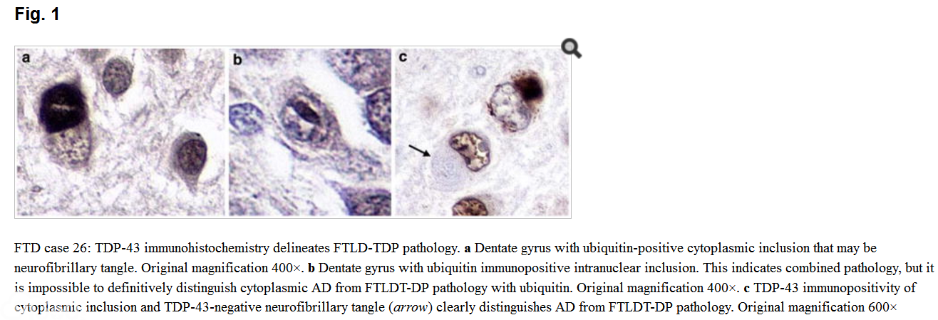 TDP-43 pathology in primary progressive aphasia and frontotemporal dementia with pathologic Alzheimer disease
