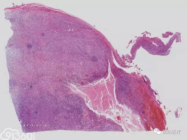 60歲女性患梭形細胞橫紋肌肉瘤入院治療病例分析