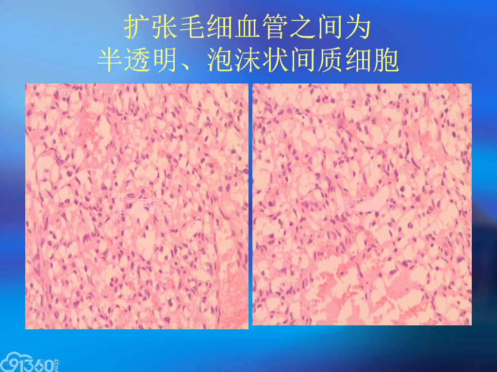 中枢神经系统少突细胞样（OLCs）/透明细胞肿瘤