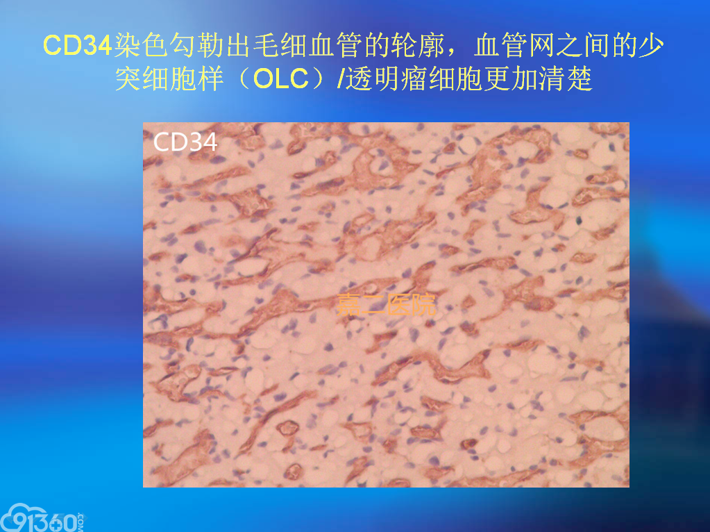 中枢神经系统少突细胞样（OLCs）/透明细胞肿瘤