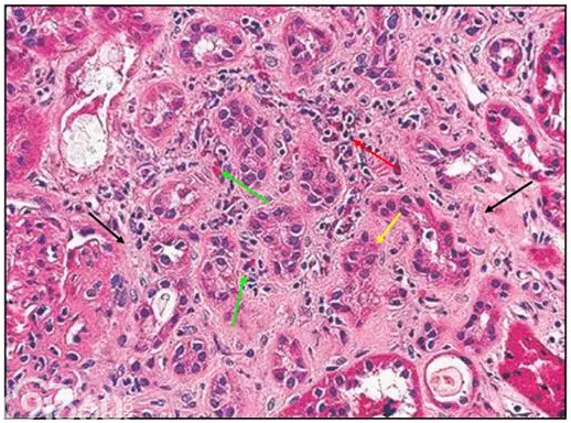 肾内病理图解：小管间质性肾炎