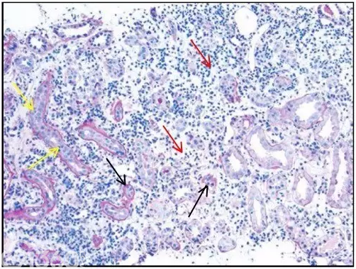 肾内病理图解：小管间质性肾炎