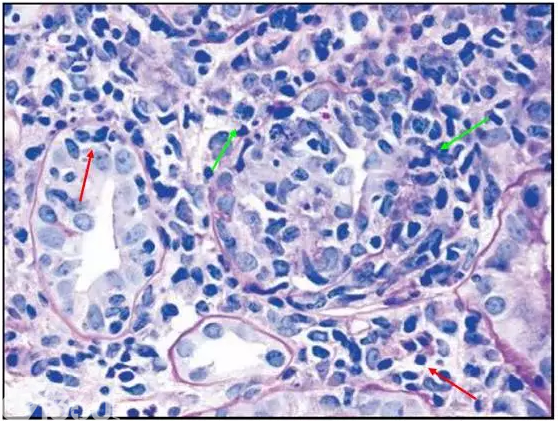 肾内病理图解：小管间质性肾炎